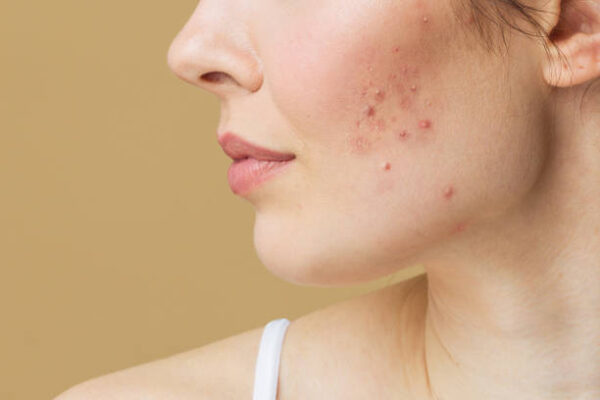 Acne Scar Treatment for Teenagers: What Parents Should Know
