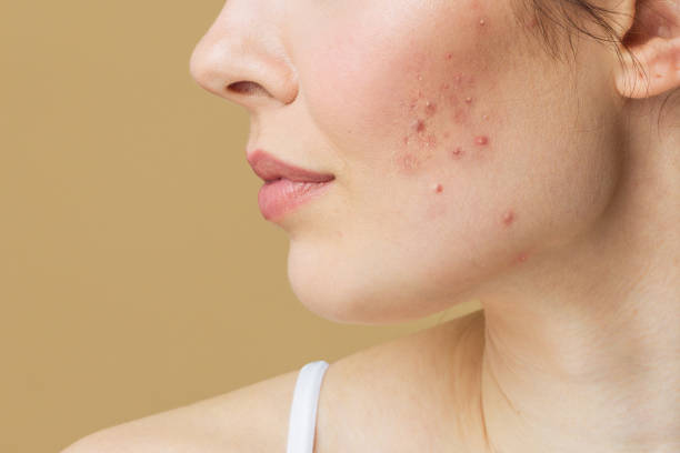 Acne Scar Treatment for Teenagers: What Parents Should Know