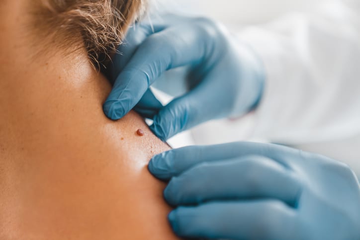 Birthmark Removal in Islamabad