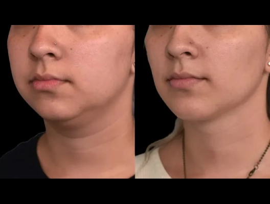 Double chin removal in Dubai