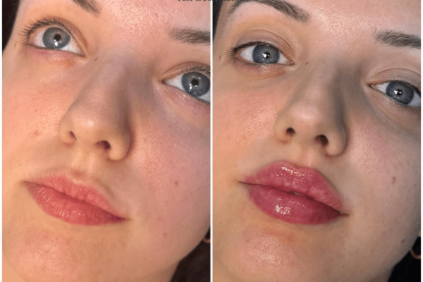 Juvederm in Dubai