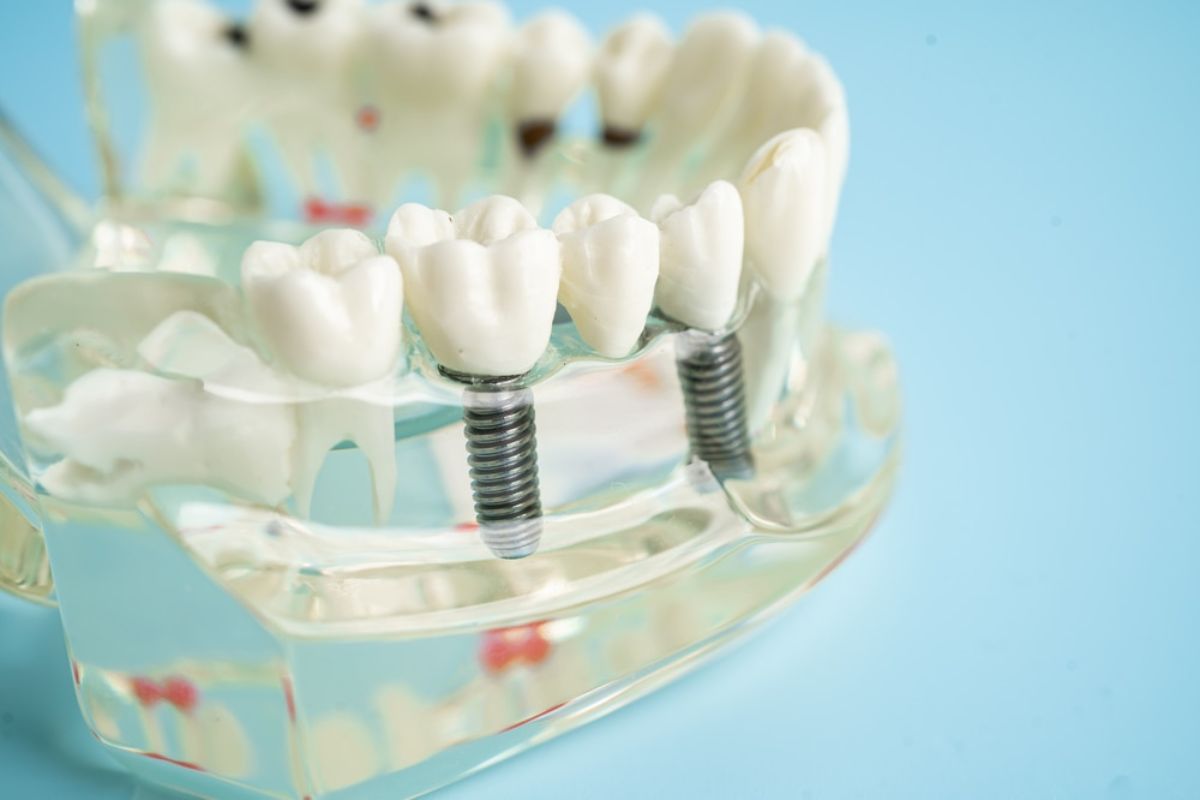 Dental Implants for Replacing Front Teeth: What You Need to Know