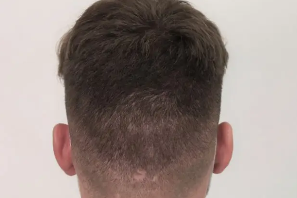 Hair Transplant
