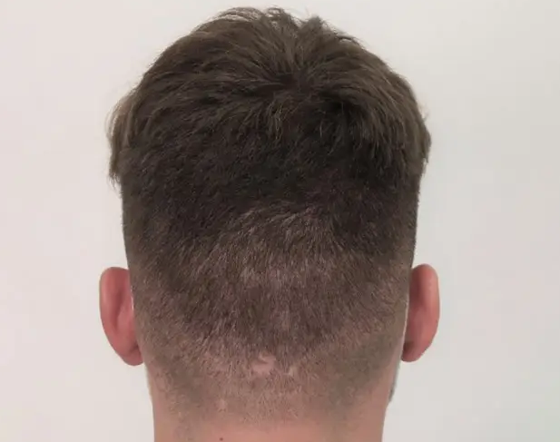 Hair Transplant
