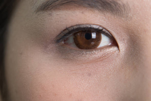 Eye Bag Treatment in Riyadh