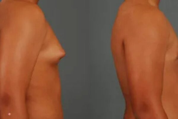 gynecomastia surgery in Delhi