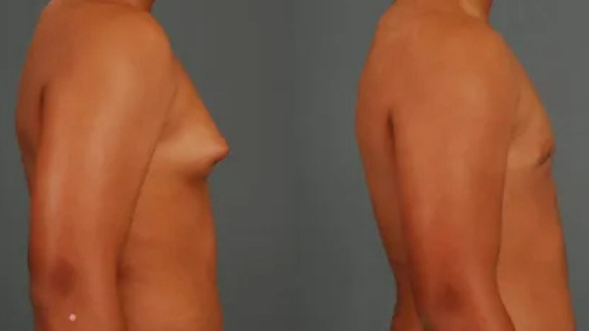 gynecomastia surgery in Delhi