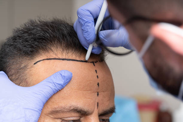 Hair Transplant in Riyadh