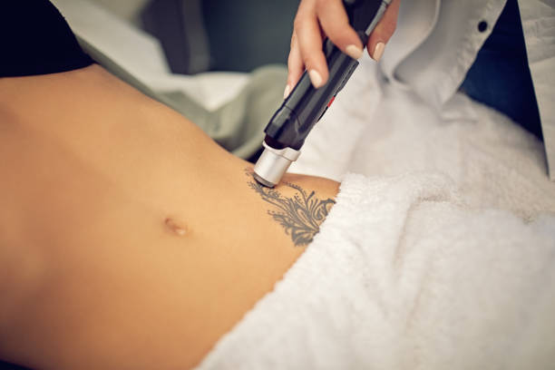 Laser Tattoo Removal in Riyadh