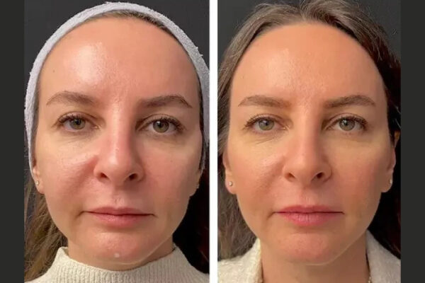 Mesotherapy in Dubai