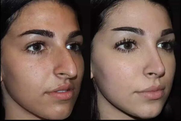 Septoplasty in Dubai