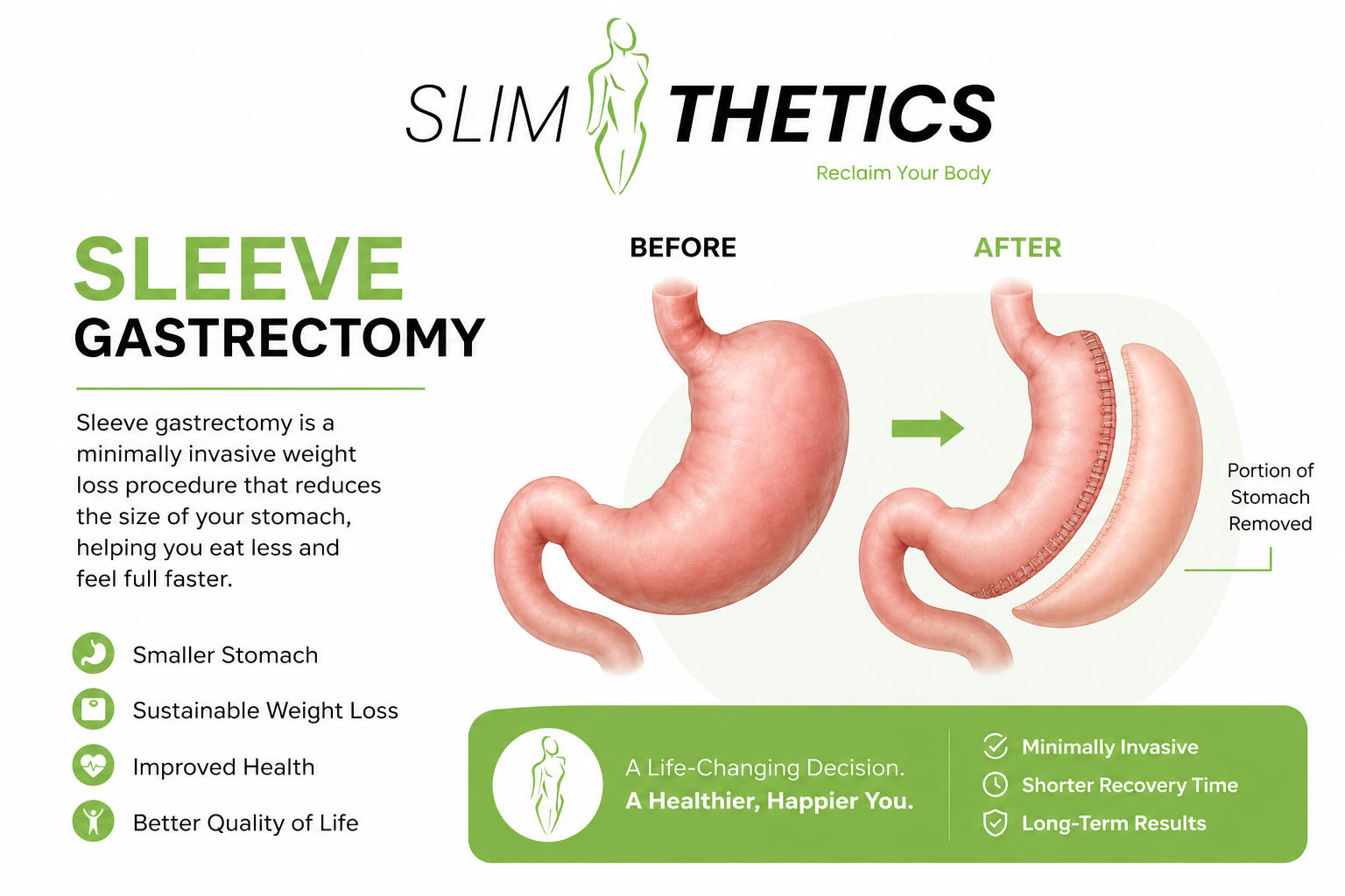 Sleeve gastrectomy in Islamabad
