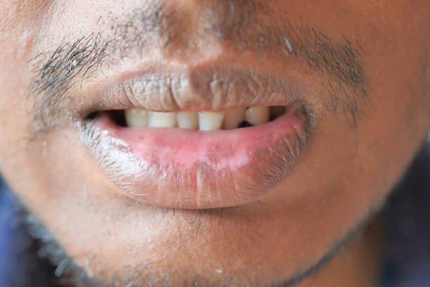 Smoker’s Lips Treatment in Riyadh