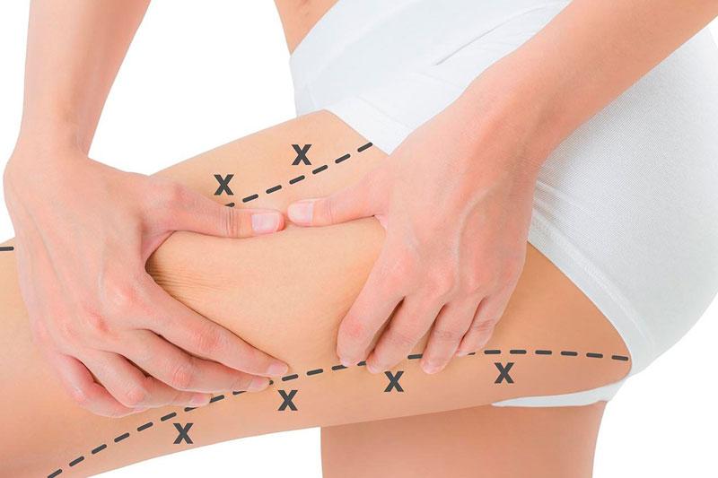 Thigh Liposuction in Islamabad