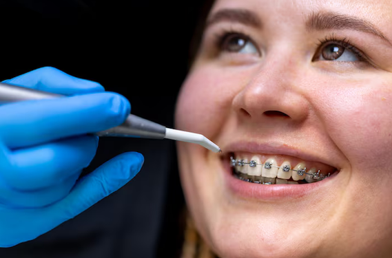 braces san antonio