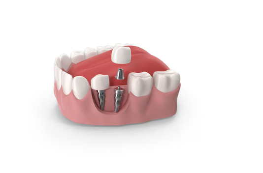 dental implants bowling green ky