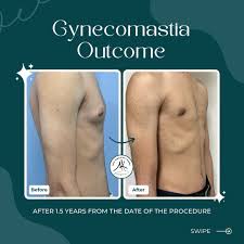 gynecomastia in islamabad