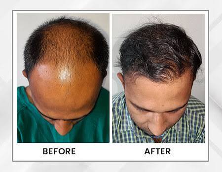 hair transplant