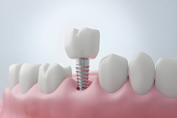 Dental Implants Aberdeen