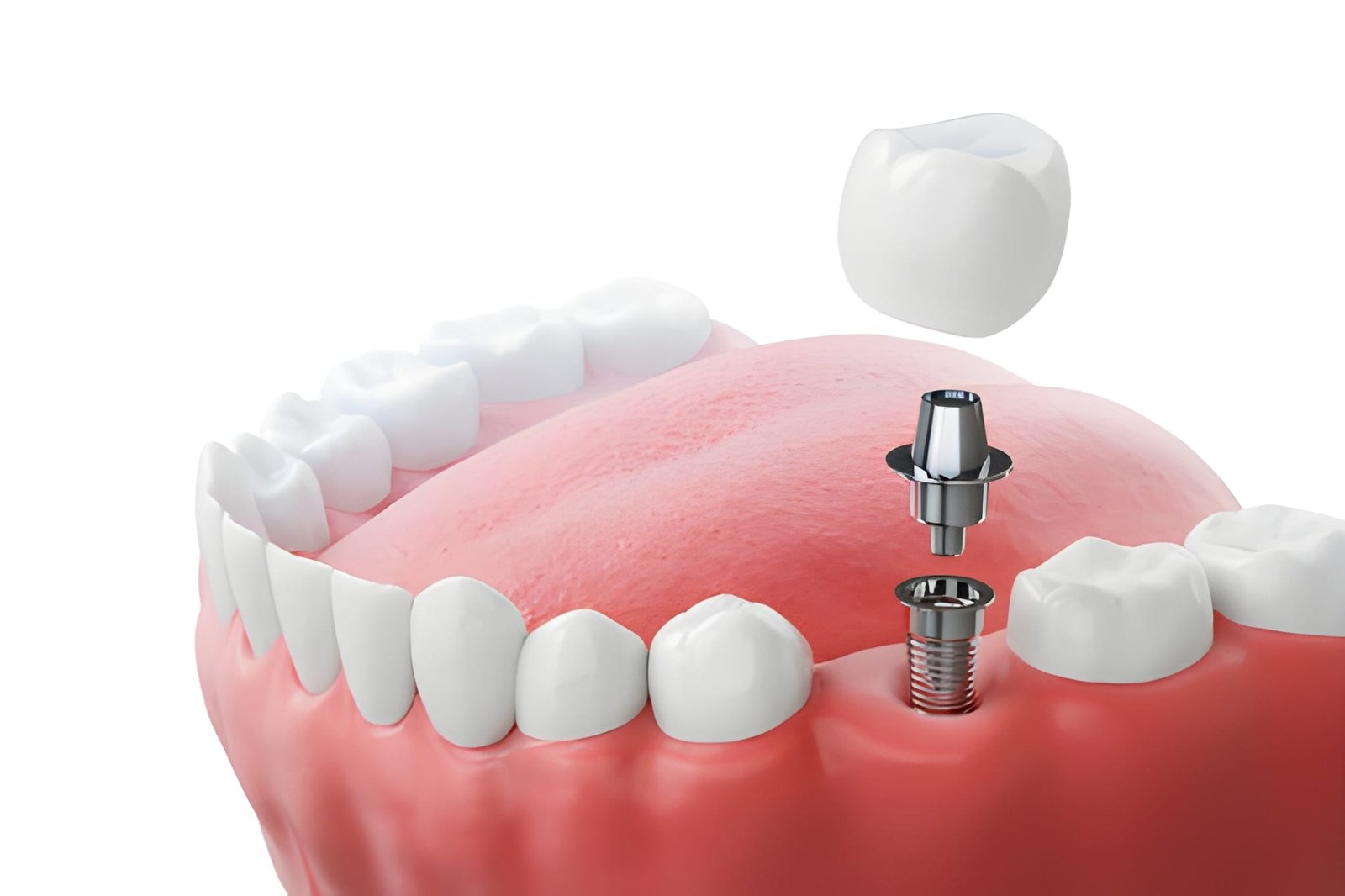 Trusted Implant Dentist in Aberdeen