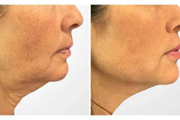 Best Plastic Surgeons in Dubai Featuring Premium Thread Lift