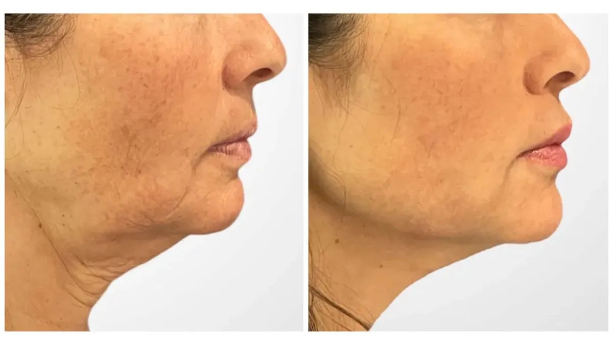 Best Plastic Surgeons in Dubai Featuring Premium Thread Lift