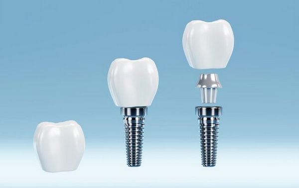 tooth implant new orleans