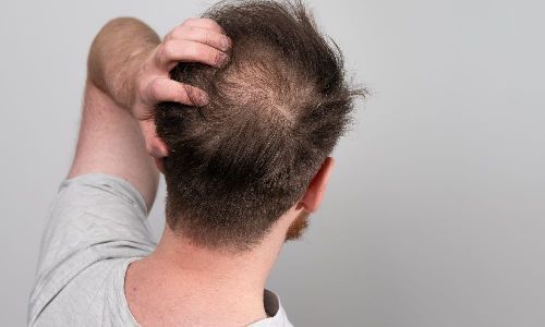 زراعة الشعر في الرياض