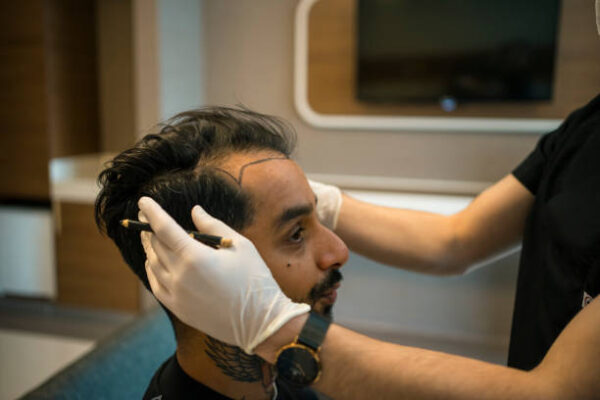 زراعة شعر الرياض