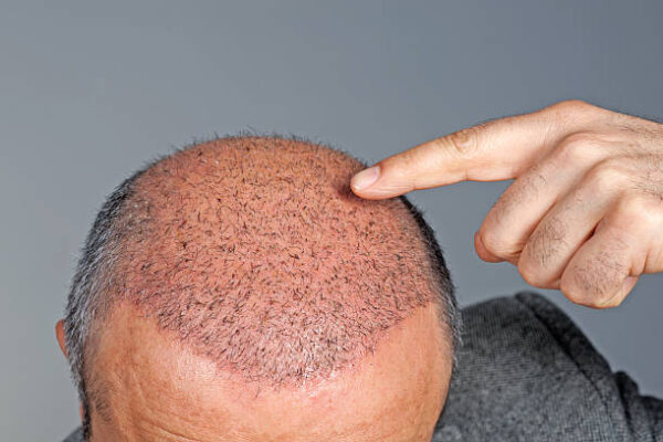 زراعة شعر الرياض