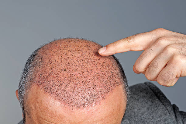زراعة شعر الرياض