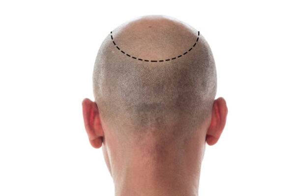 زراعة شعر الرياض