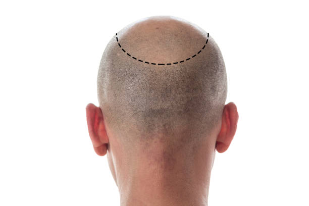 زراعة شعر الرياض