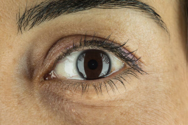 Eyebag Removal in Riyadh