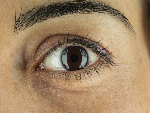 Eyebag Removal in Riyadh