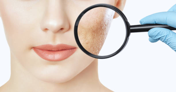 laser acne scar treatment near me
