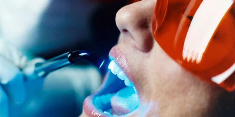 Tooth Bleaching