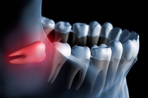 Dental Veneers Quezon City